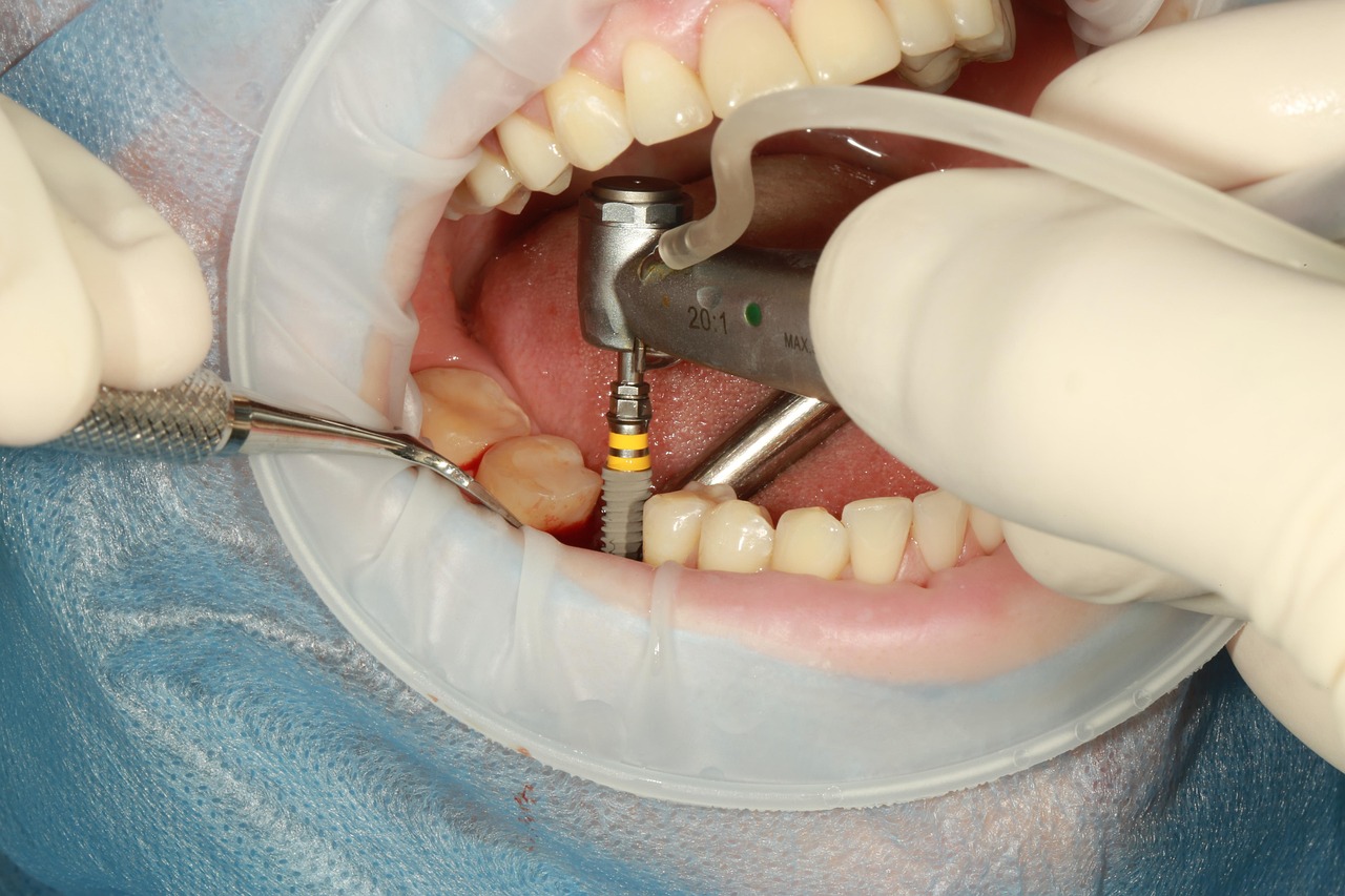 Dental Implant Model